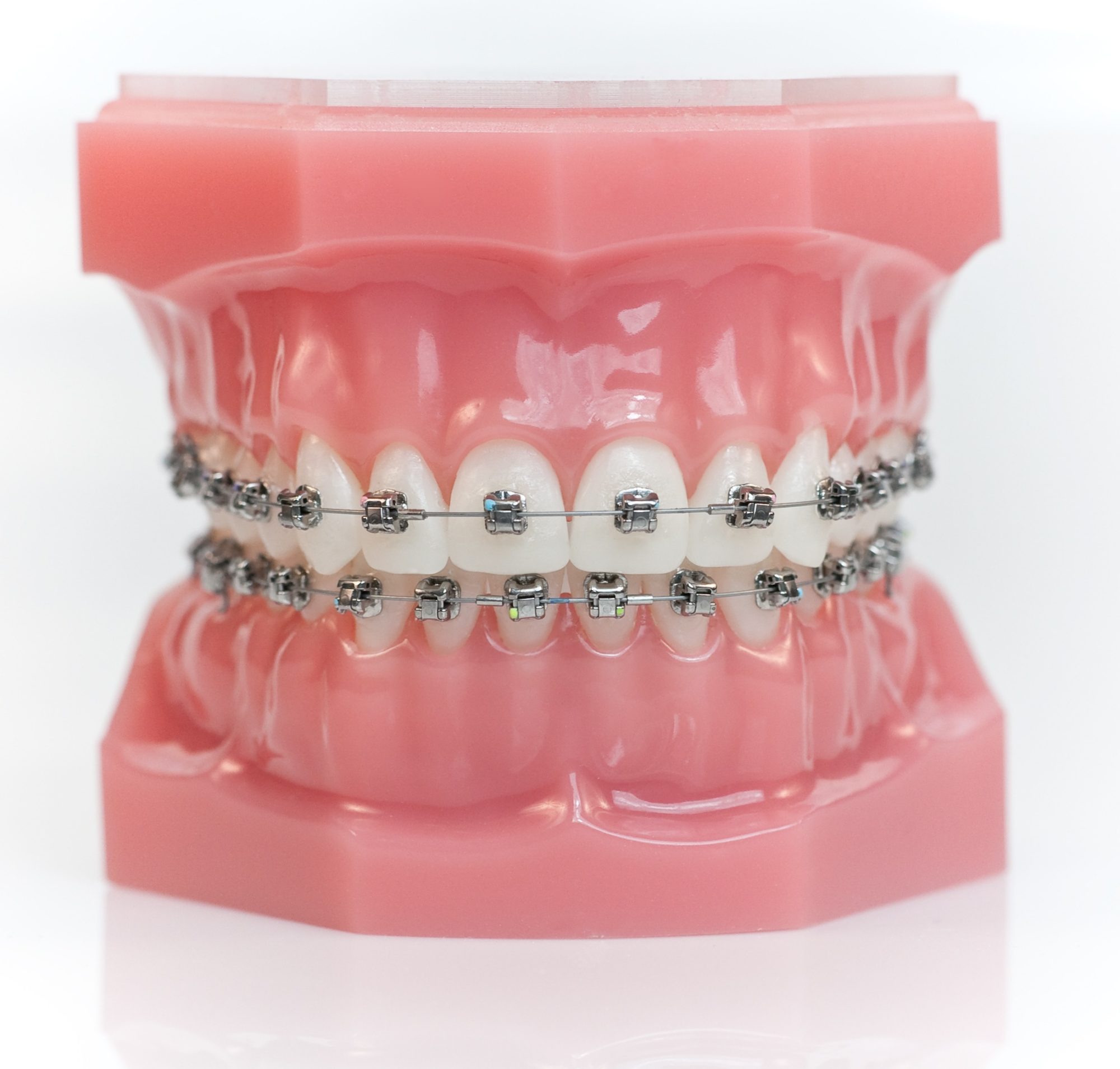 Damon_Braces_Typodont orthodontist owensboro ky