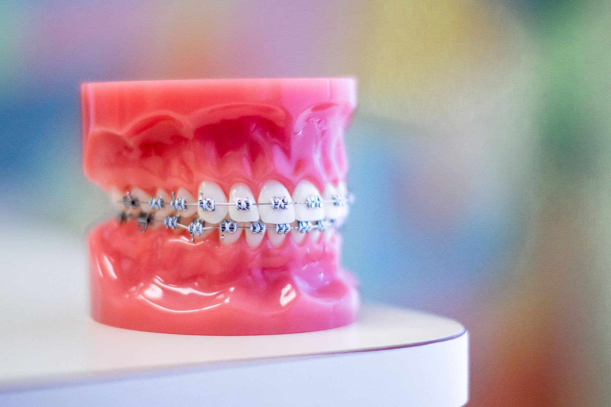 Model of teeth with metal braces, demonstrating orthodontic treatment, against a colorful background, relevant to Danzer Orthodontics services.
