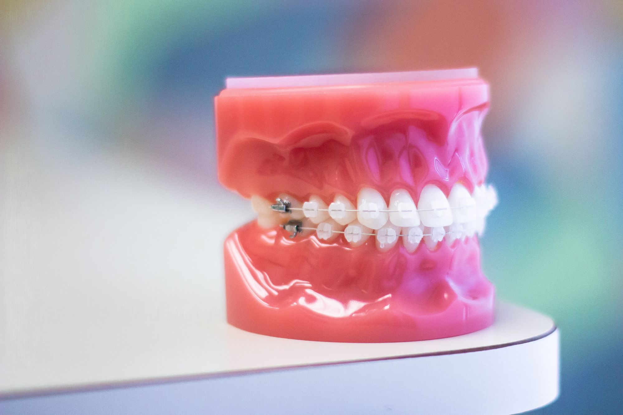 Model of teeth with clear braces on display, illustrating orthodontic treatment options at Danzer Orthodontics.