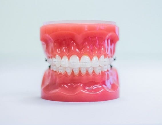 treatment-ceramic-braces (2) braces beaver dam ky