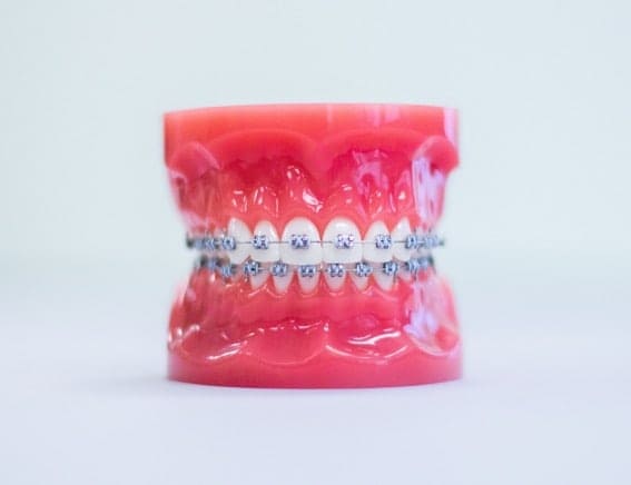 treatment-metal-braces (2) braces beaver dam ky